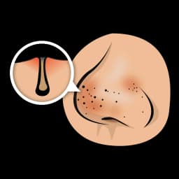 Reduces Blackheads